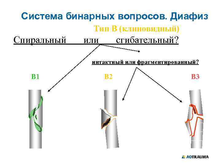 Система бинарных вопросов. Диафиз Тип В (клиновидный) Спиральный или сгибательный? интактный или фрагментированный? В