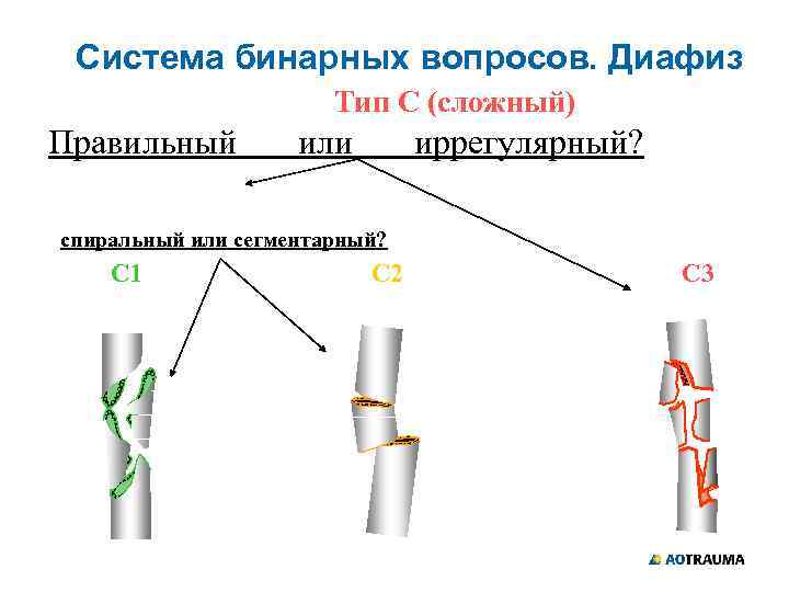 Система бинарных вопросов. Диафиз Тип С (сложный) Правильный или иррегулярный? спиральный или сегментарный? С