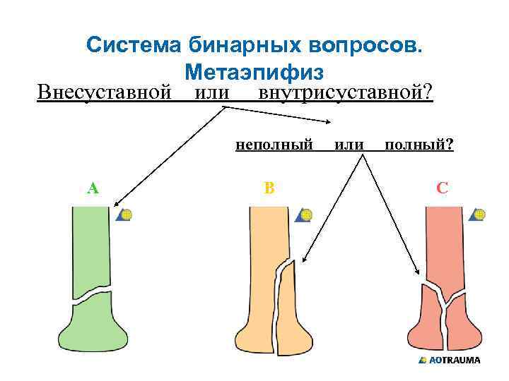 Система бинарных вопросов. Метаэпифиз Внесуставной или внутрисуставной? неполный А В или полный? С 