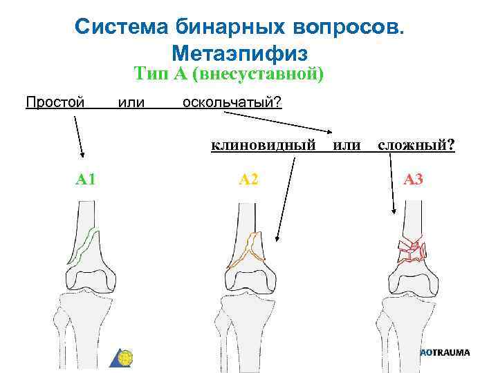 Система бинарных вопросов. Метаэпифиз Тип А (внесуставной) Простой или оскольчатый? клиновидный А 1 А