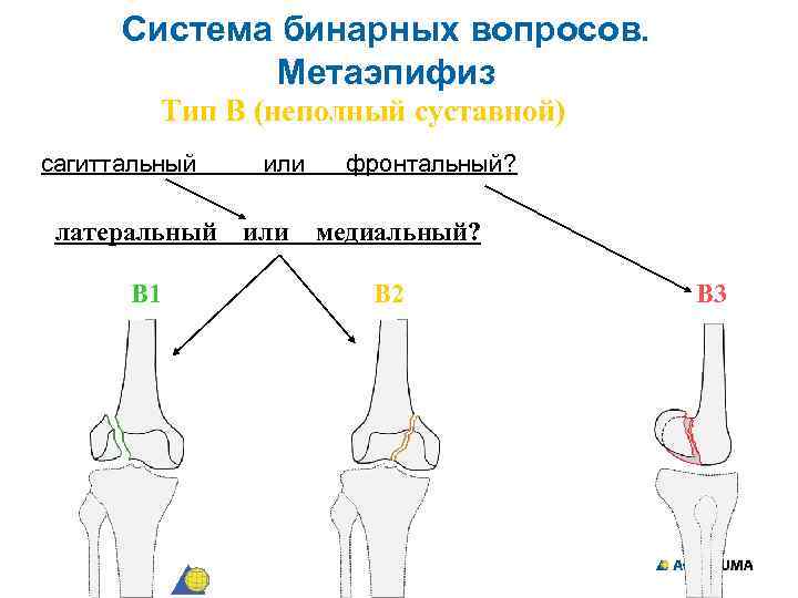 Система бинарных вопросов. Метаэпифиз Тип В (неполный суставной) сагиттальный латеральный В 1 или фронтальный?