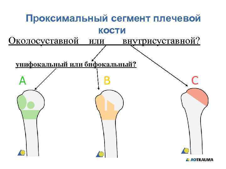 Проксимальные переломы плечевой кости