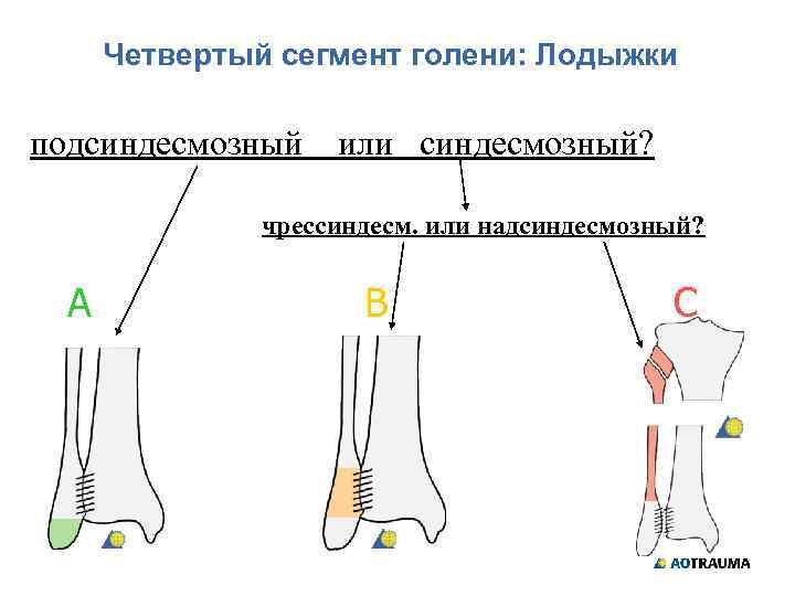 Четвертый сегмент голени: Лодыжки подсиндесмозный или синдесмозный? чрессиндесм. или надсиндесмозный? А В С 