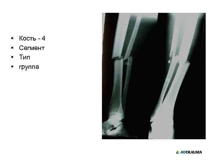  • • Кость - 4 Сегмент Тип группа 