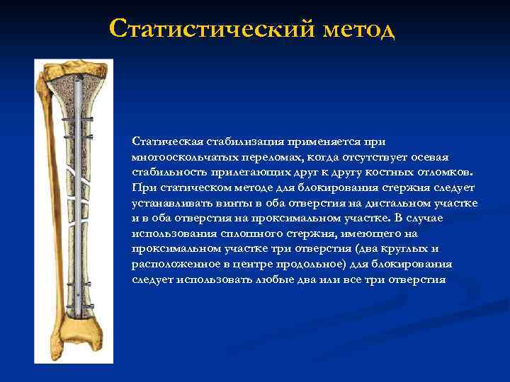 Статистический метод Статическая стабилизация применяется при многооскольчатых переломах, когда отсутствует осевая стабильность прилегающих друг