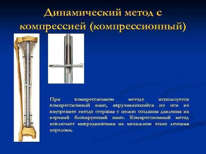 Динамический метод с компрессией (компрессионный) При компрессионном методе используется компрессионный винт, вкручивающийся по оси