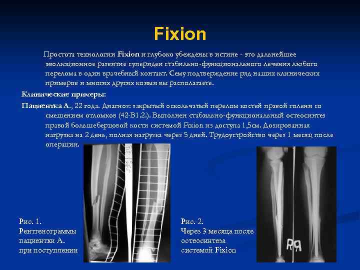 Fixion Простота технологии Fixion и глубоко убеждены в истине - это дальнейшее эволюционное развитие