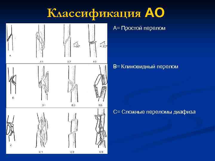 Перелом диафиза бедра презентация