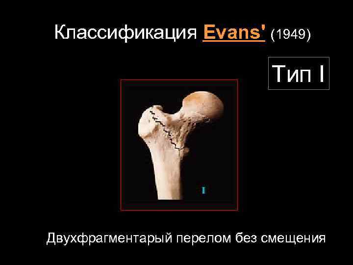 Классификация Evans' (1949) Тип I Двухфрагментарый перелом без смещения 