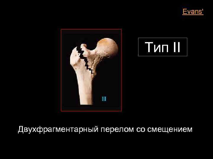 Evans' Тип II Двухфрагментарный перелом со смещением 