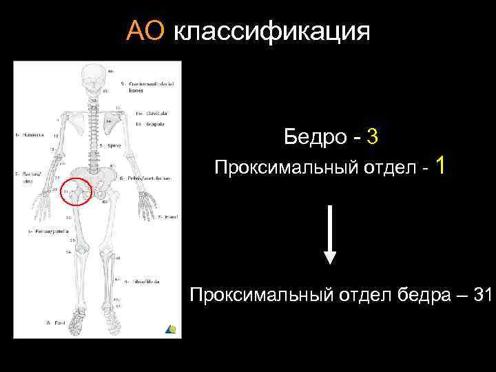 АО классификация Бедро - 3 Проксимальный отдел - 1 Проксимальный отдел бедра – 31