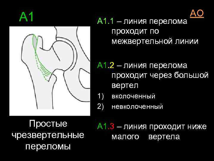 Перелом бедренного вертела. Вколоченный перелом шейки бедра классификация. Проксимальные переломы бедра классификация. Чрезвертельные переломы бедренной кости классификация. Чрезвертельный перелом бедренной кости классификация.