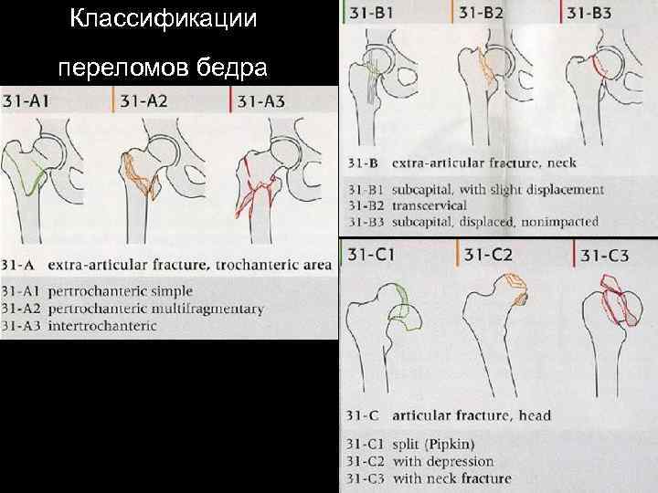 Классификация переломов