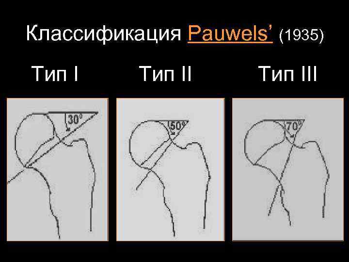 Классификация Pauwels’ (1935) Тип III 