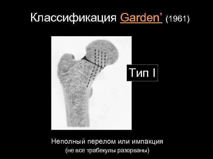 Классификация Garden’ (1961) Тип I Неполный перелом или импакция (не все трабекулы разорваны) 