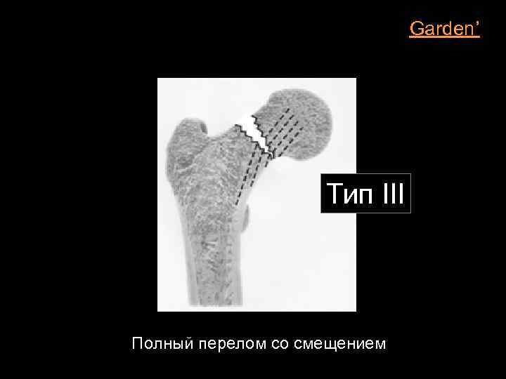 Garden’ Тип III Полный перелом со смещением 