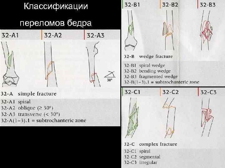 Переломы бедренной кости тесты с ответами. Классификация Мюллера переломы бедра. Классификация переломов по Мюллеру. Универсальная классификация переломов.