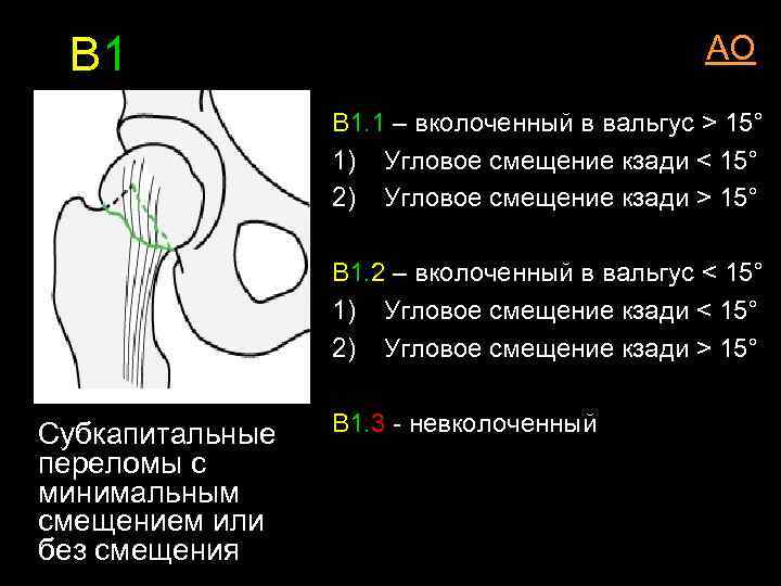 В 1 АО В 1. 1 – вколоченный в вальгус > 15° 1) Угловое