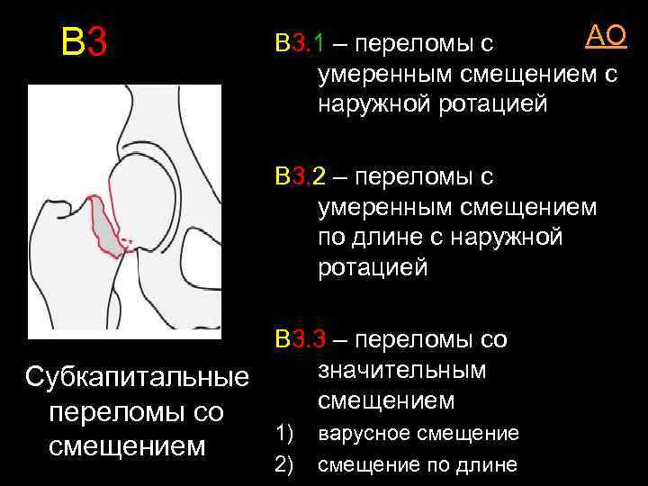 В 3 АО В 3. 1 – переломы с умеренным смещением c наружной ротацией