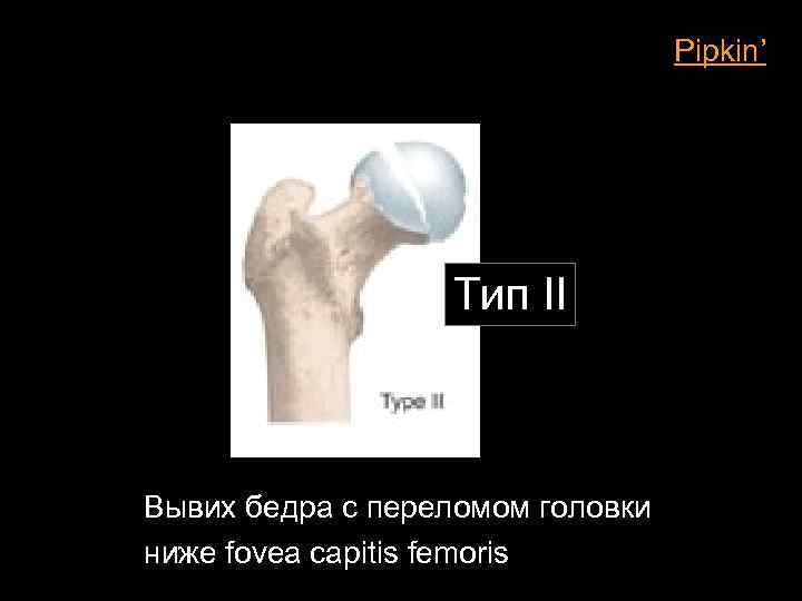 Pipkin’ Тип II Вывих бедра с переломом головки ниже fovea capitis femoris 