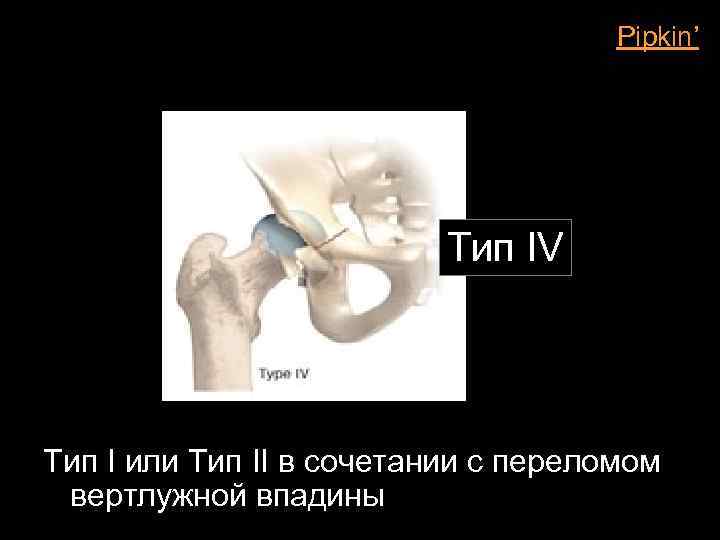 Pipkin’ Тип IV Тип I или Тип II в сочетании с переломом вертлужной впадины