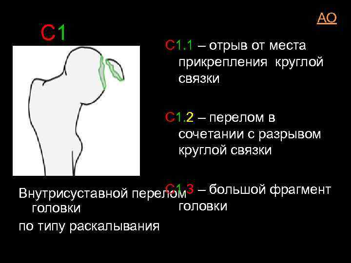 C 1 AO С 1. 1 – отрыв от места прикрепления круглой связки С