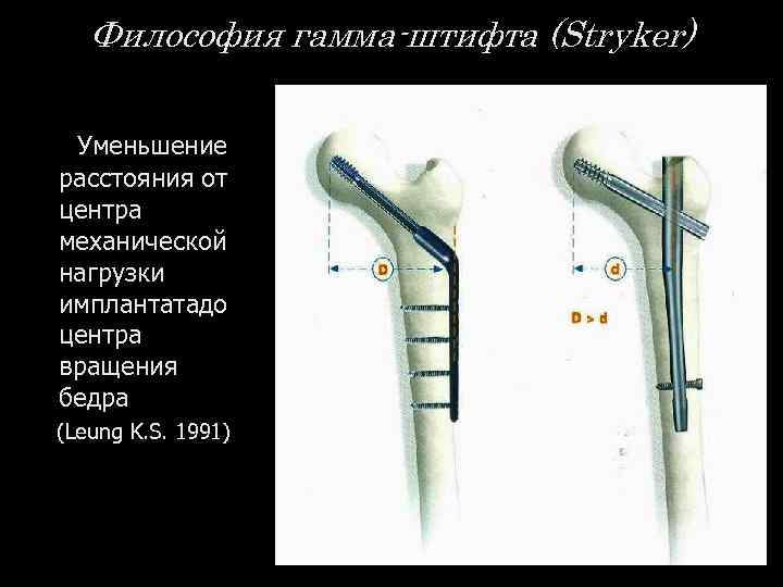 Философия гамма-штифта (Stryker) Уменьшение расстояния от центра механической нагрузки имплантатадо центра вращения бедра (Leung