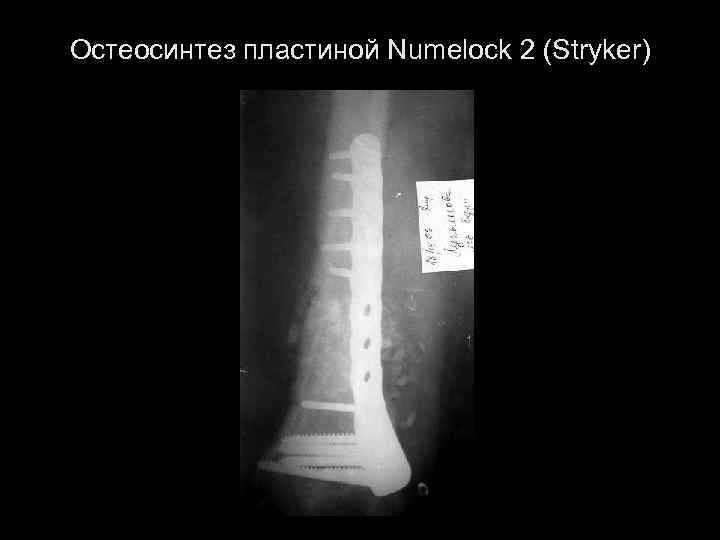 Остеосинтез пластиной Numelock 2 (Stryker) 