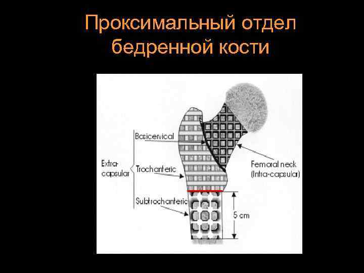 Проксимальный отдел бедренной кости 