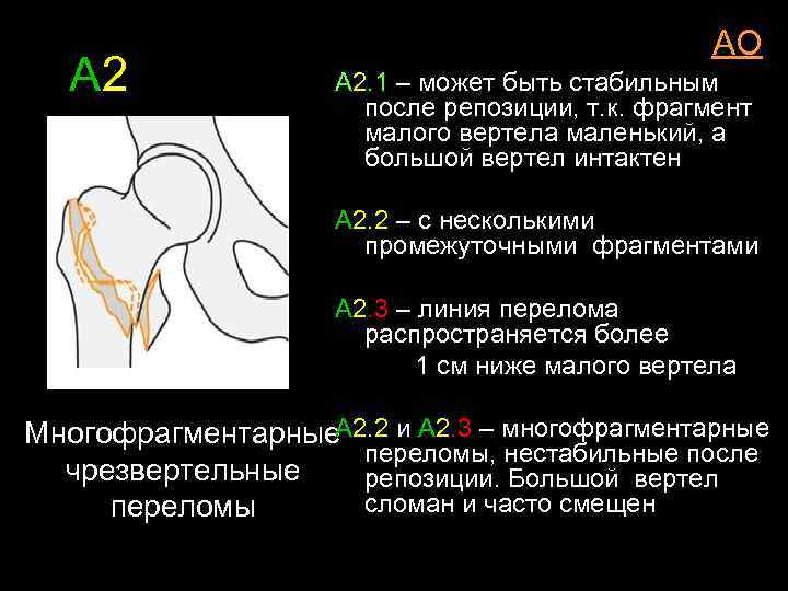 А 2 АО А 2. 1 – может быть стабильным после репозиции, т. к.