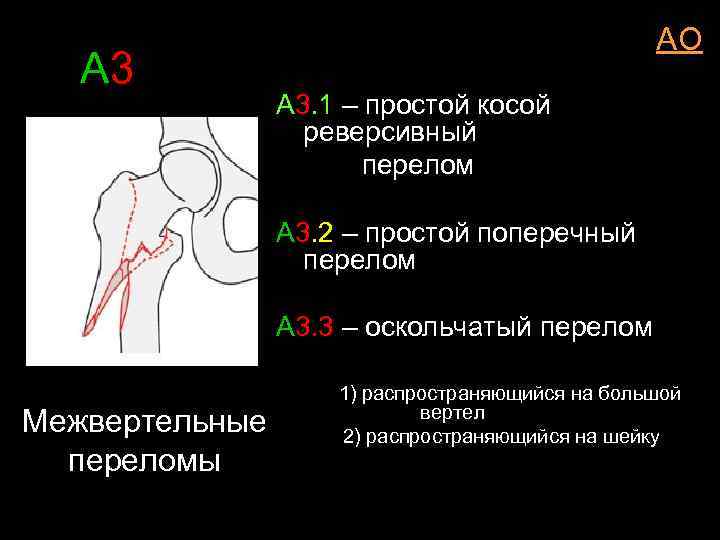 А 3 АО А 3. 1 – простой косой реверсивный перелом А 3. 2