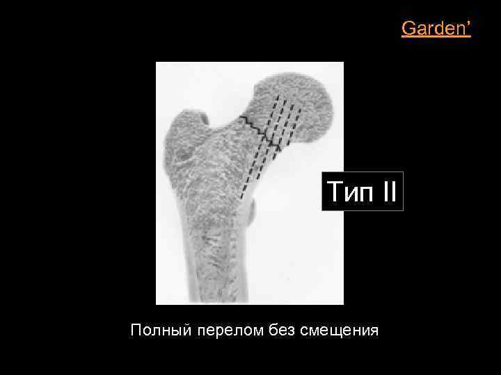 Garden’ Тип II Полный перелом без смещения 