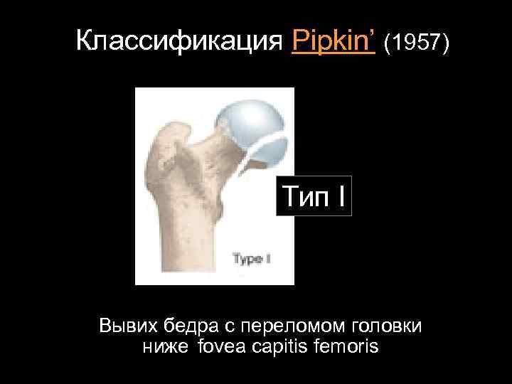 Классификация Pipkin’ (1957) Тип I Вывих бедра с переломом головки ниже fovea capitis femoris