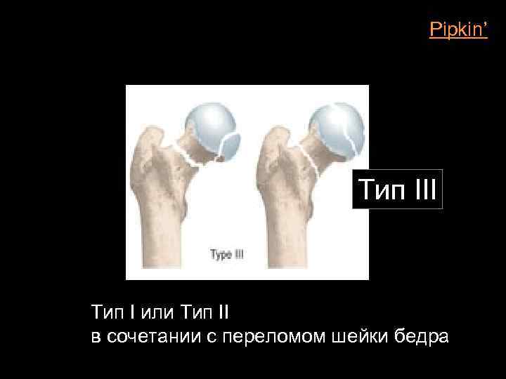 Pipkin’ Тип III Тип I или Тип II в сочетании с переломом шейки бедра