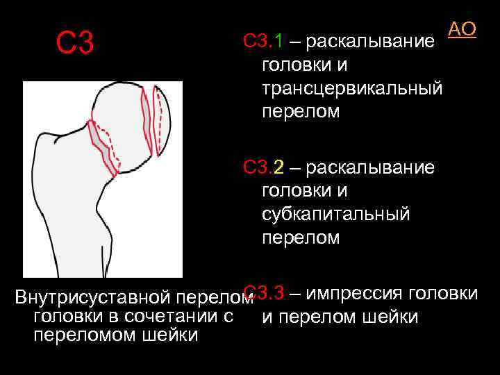 С 3 С 3. 1 – раскалывание головки и трансцервикальный перелом AO С 3.