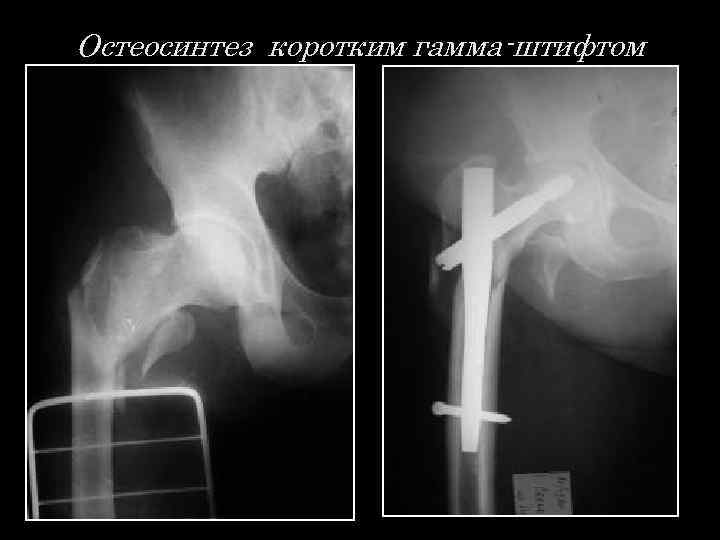 Остеосинтез коротким гамма-штифтом 
