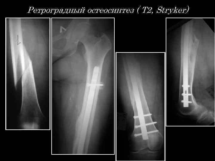 Ретроградный остеосинтез ( Т 2, Stryker) 