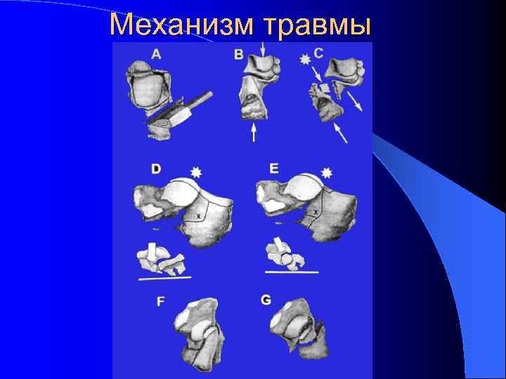 Механизм травмы 