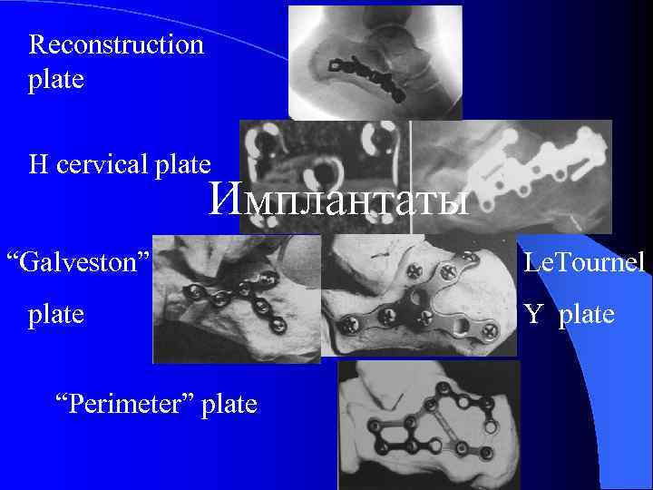 Reconstruction plate H cervical plate Имплантаты “Galveston” plate “Perimeter” plate Le. Tournel Y plate