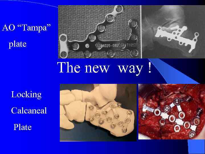 AO “Tampa” plate The new way ! Locking Calcaneal Plate 