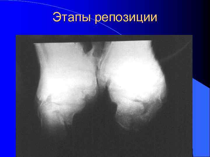 Этапы репозиции 