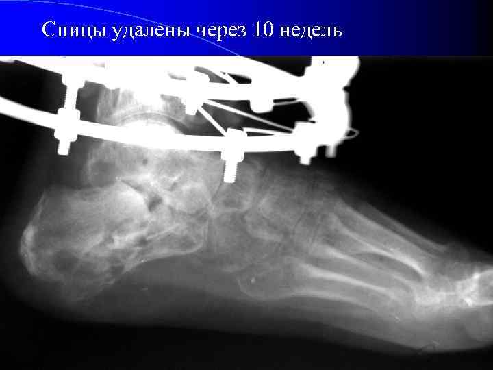 Спицы удалены через 10 недель 