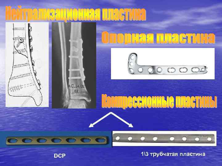 DCP 13 трубчатая пластина 