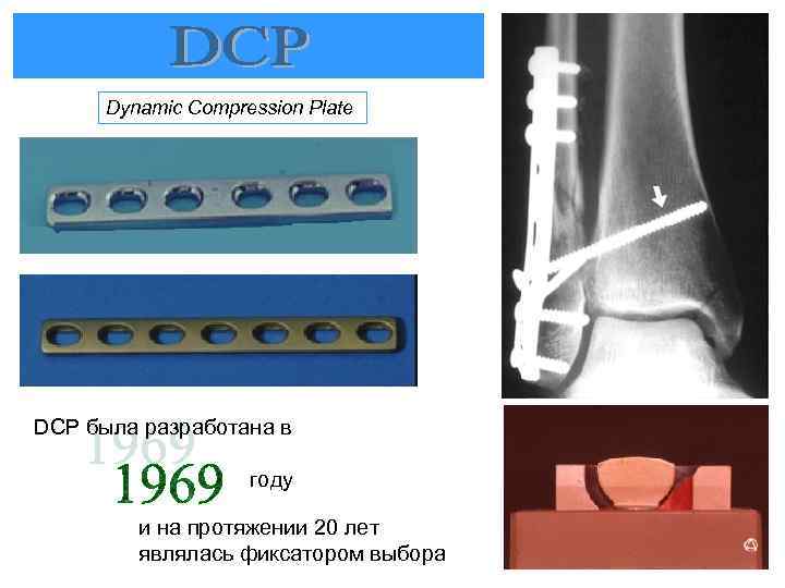 Dynamic Compression Plate DCP была разработана в году и на протяжении 20 лет являлась