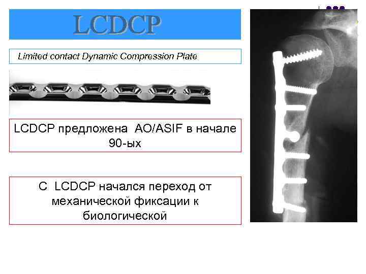 Limited contact Dynamic Compression Plate LCDCP предложена AO/ASIF в начале 90 -ых С LCDCP