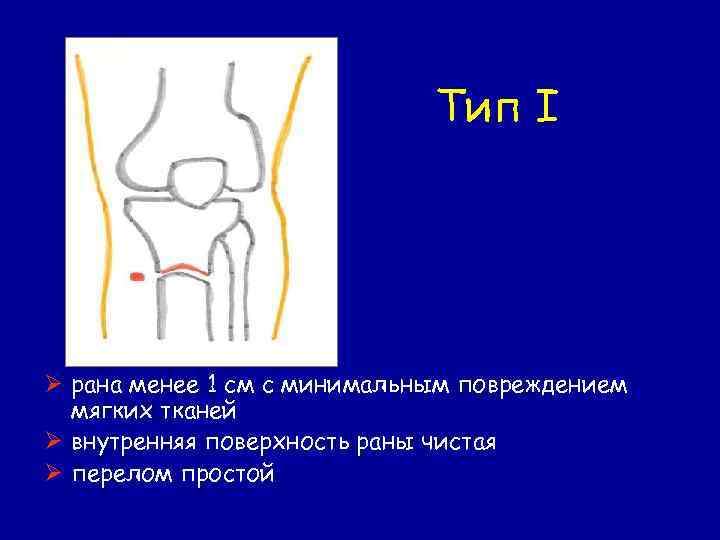 Тип I Ø рана менее 1 см с минимальным повреждением мягких тканей Ø внутренняя