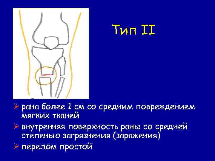 Тип II Ø рана более 1 см со средним повреждением мягких тканей Ø внутренняя