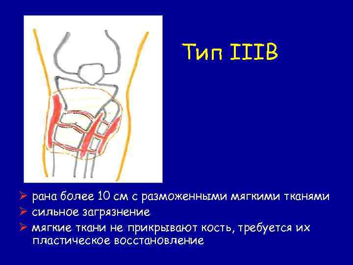 Тип IIIB Ø рана более 10 см с разможенными мягкими тканями Ø сильное загрязнение