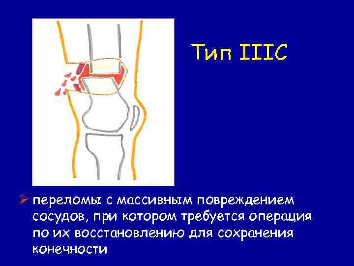 Тип IIIC Ø переломы с массивным повреждением сосудов, при котором требуется операция по их