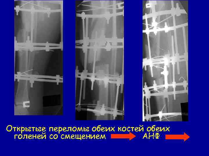 Открытые переломы обеих костей обеих голеней со смещением АНФ 